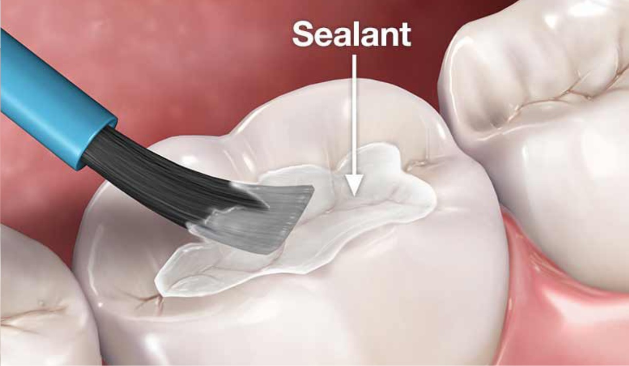 TPMD dr. Bram Natanael - Pelayanan Hebat Pengobatan Tepat - Klinik Terbaik di Kota Medan - Fissure Sealant: Perlindungan Penting untuk Gigi Berlubang