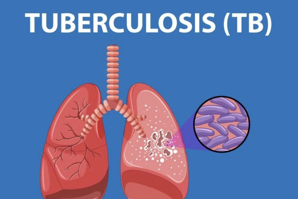 TPMD dr. Bram Natanael - Pelayanan Hebat Pengobatan Tepat - Klinik Terbaik di Kota Medan - WHO Tetapkan Tuberkulosis Sebagai Penyakit Menular Paling Mematikan Dr.Bram Sembiring : Jangan Takut untuk Berobat Tuberkulosis Bisa Sembuh